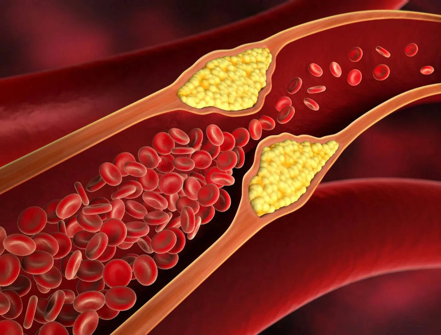 Illustration of cholesterol buildup in an artery